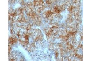 Formalin-fixed, paraffin-embedded human renal cell carcinoma stained with Cadherin 16 antibody (CDH16/1071) (Cadherin-16 anticorps)