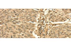 Immunohistochemistry of paraffin-embedded Human lung cancer using SEPT2 Polyclonal Antibody at dilution of 1/30