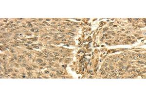 Immunohistochemistry of paraffin-embedded Human lung cancer using SEPT2 Polyclonal Antibody at dilution of 1/30 (Septin 2 anticorps)