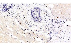 Detection of PD1 in Human Breast cancer Tissue using Polyclonal Antibody to Programmed Cell Death Protein 1 (PD1) (PD-1 anticorps  (AA 41-132))