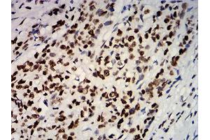 Immunohistochemical analysis of paraffin-embedded breast cancer tissues using ESR1 mouse mAb with DAB staining.