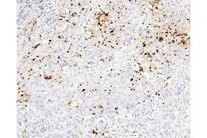 IHC analysis of CEACAM5 using anti-CEACAM5 antibody (ABIN7601435). (CEACAM5 anticorps  (AA 35-650))