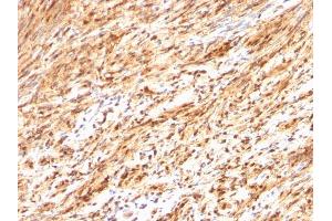 Formalin-fixed, paraffin-embedded human Schwanoma stained with S100B Rabbit Polyclonal Antibody.
