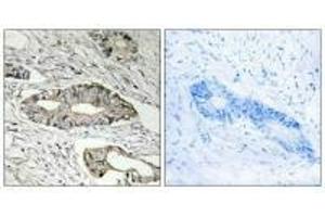 Immunohistochemistry analysis of paraffin-embedded human colon carcinoma tissue, using EPN3 antibody. (EPN3 anticorps)