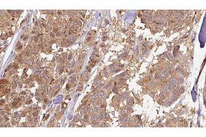 ABIN6278939 at 1/100 staining Human Melanoma tissue by IHC-P.