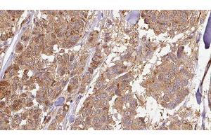 ABIN6278939 at 1/100 staining Human Melanoma tissue by IHC-P. (CYB5R4 anticorps  (N-Term))