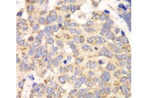 Immunohistochemistry of paraffin-embedded Human esophageal cancer using HAGH Polyclonal Antibody at dilution of 1:100 (40x lens). (HAGH anticorps)