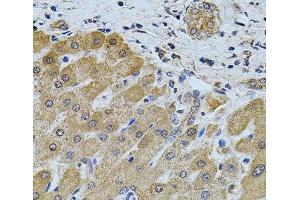 Immunohistochemistry of paraffin-embedded Human liver damage using FoxO3a Polyclonal Antibody at dilution of 1:100 (40x lens). (FOXO3 anticorps)