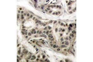 Immunohistochemistry of paraffin-embedded human breast carcinoma using Phospho-NFKB1-S337 antibody (ABIN2987371). (NFKB1 anticorps  (pSer337))