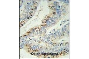 PHL Antibody (C-term) (ABIN652395 and ABIN2841923) IHC analysis in formalin fixed and paraffin embedded colon carcinoma followed by peroxidase conjugation of the secondary antibody and DAB staining. (PHLPP2 anticorps  (C-Term))