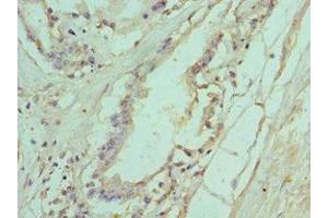 Immunohistochemistry of paraffin-embedded human prostate tissue using ABIN7156772 at dilution of 1:100 (IL11RA anticorps  (AA 30-290))