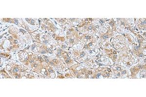 Immunohistochemistry of paraffin-embedded Human liver cancer tissue using DHX58 Polyclonal Antibody at dilution of 1:60(x200) (DHX58 anticorps)