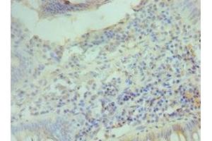 Immunohistochemistry of paraffin-embedded human colon cancer using ABIN7153389 at dilution of 1:100