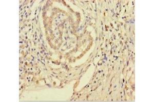 Immunohistochemistry of paraffin-embedded human pancreatic cancer using ABIN7170557 at dilution of 1:100