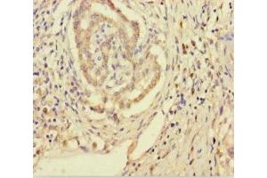 Immunohistochemistry of paraffin-embedded human pancreatic cancer using ABIN7170557 at dilution of 1:100 (SMPD3 anticorps  (AA 401-655))