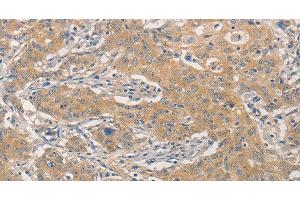 Immunohistochemistry of paraffin-embedded Human gastric cancer using NFE2L1 Polyclonal Antibody at dilution of 1:30 (NFE2L1 anticorps)