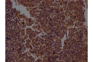 IHC image of ABIN7127384 diluted at 1:100 and staining in paraffin-embedded human lung cancer performed on a Leica BondTM system. (Recombinant Caspase 2 anticorps)