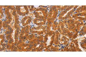 Immunohistochemistry of paraffin-embedded Human thyroid cancer tissue using TNFRSF8 Polyclonal Antibody at dilution 1:60 (TNFRSF8 anticorps)