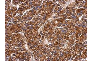 IHC-P Image Immunohistochemical analysis of paraffin-embedded human hepatoma, using MMAB, antibody at 1:500 dilution. (MMAB anticorps  (Center))