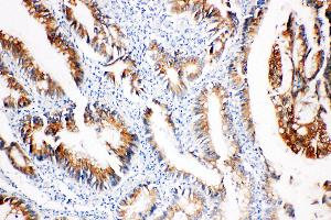 Anti-COX2/Cyclooxygenase 2 antibody, IHC(P) IHC(P): Human Intestinal Cancer Tissue (PTGS2 anticorps  (C-Term))