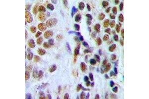 Immunohistochemical analysis of DDB2 staining in human breast cancer formalin fixed paraffin embedded tissue section.