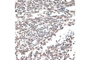 Immunohistochemistry of paraffin-embedded human lung cancer using AQR antibody (ABIN6133411, ABIN6137057, ABIN6137058 and ABIN6221662) at dilution of 1:100 (40x lens). (AQR anticorps  (AA 400-700))
