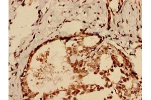 Immunohistochemistry analysis of human breast cancer using ABIN7147553 at dilution of 1:100