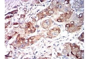 Immunohistochemical analysis of paraffin-embedded liver cancer tissues using ASGR2 mouse mAb with DAB staining.