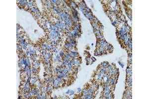 Immunohistochemistry of paraffin-embedded Human gastric cancer using MRPL28 Polyclonal Antibody at dilution of 1:100 (40x lens). (MRPL28 anticorps)