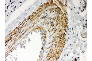 IHC-P: PKC iota antibody testing of human lung cancer tissue (PKC iota anticorps  (AA 21-214))