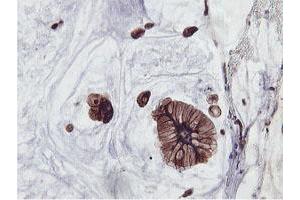 Immunohistochemical staining of paraffin-embedded Adenocarcinoma of Human colon tissue using anti-PFKP mouse monoclonal antibody. (PFKP anticorps)
