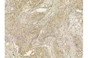 ABIN6262132 and ABIN6276632 at 1/100 staining human cervical carcinoma by IHC-P.