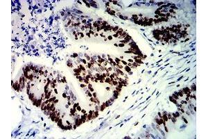Immunohistochemical analysis of paraffin-embedded colon cancer tissues using MKI67 mouse mAb with DAB staining.