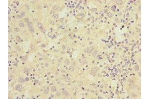 Immunohistochemistry of paraffin-embedded human liver cancer using ABIN7175576 at dilution of 1:100