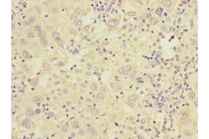 Immunohistochemistry of paraffin-embedded human liver cancer using ABIN7175576 at dilution of 1:100 (CACNG7 anticorps  (AA 156-275))