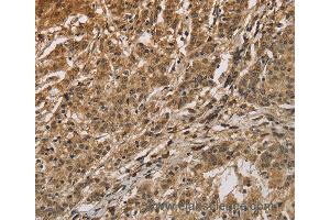 Immunohistochemistry of Human gastric cancer using CALU Polyclonal Antibody at dilution of 1:40 (CALU anticorps)