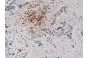 IHC-P analysis of Human Breast Cancer Tissue, with DAB staining. (CPB2 anticorps  (AA 138-423))