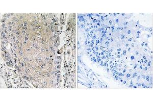 Immunohistochemistry analysis of paraffin-embedded human lung carcinoma tissue using CBLN3 antibody. (CBLN3 anticorps)