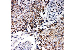 Anti-REA antibody, IHC(P) IHC(P): Human Lung Cancer Tissue (Prohibitin 2 anticorps  (Middle Region))