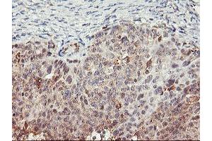 Immunohistochemical staining of paraffin-embedded Adenocarcinoma of Human ovary tissue using anti-TULP3 mouse monoclonal antibody. (TULP3 anticorps)