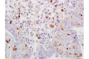Formalin-fixed and paraffin embedded human lung carcinoma labeled with Rabbit Anti-JNK1/2/3 Polyclonal Antibody, Unconjugated (ABIN747713) at 1:200 followed by conjugation to the secondary antibody and DAB staining (JNK anticorps  (AA 151-250))