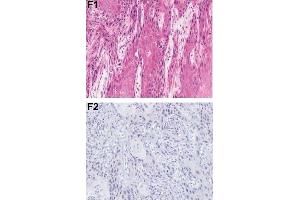 Immunohistochemical analysis of PDCD4 shows the corresponding H&E-stained and PDCD4-stained tissue sections from patients with OSCC.