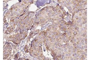 ABIN6272975 at 1/100 staining Human breast cancer tissue by IHC-P. (PPAT anticorps  (N-Term))