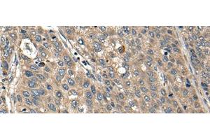 Immunohistochemistry of paraffin-embedded Human liver cancer tissue using FCGR1A Polyclonal Antibody at dilution of 1:35(x200) (FCGR1A anticorps)