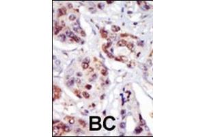 Formalin-fixed and paraffin-embedded human cancer tissue reacted with the primary antibody, which was peroxidase-conjugated to the secondary antibody, followed by AEC staining. (PIP5K2 gamma (AA 333-364), (C-Term) anticorps)