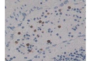Detection of Ntn4 in Human Lung Cancer Tissue using Polyclonal Antibody to Netrin 4 (Ntn4)