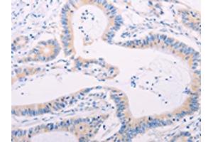 The image on the left is immunohistochemistry of paraffin-embedded Human colon cancer tissue using ABIN7189656(ADAMTS17 Antibody) at dilution 1/60, on the right is treated with synthetic peptide. (ADAMTS17 anticorps)