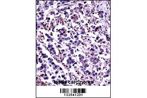 CAPN11 Antibody immunohistochemistry analysis in formalin fixed and paraffin embedded human testis carcinoma followed by peroxidase conjugation of the secondary antibody and DAB staining. (CAPN11 anticorps  (AA 409-438))