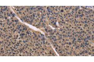 Immunohistochemistry of paraffin-embedded Human liver cancer using IDH1 Polyclonal Antibody at dilution of 1:50 (IDH1 anticorps)