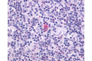Anti-CXCR5 antibody IHC of human Lymph Node, Hodgkins Lymphoma.